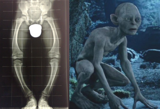 A sinistra; radiografia di un bambino affetto da rachitismo. A destra: Gollum